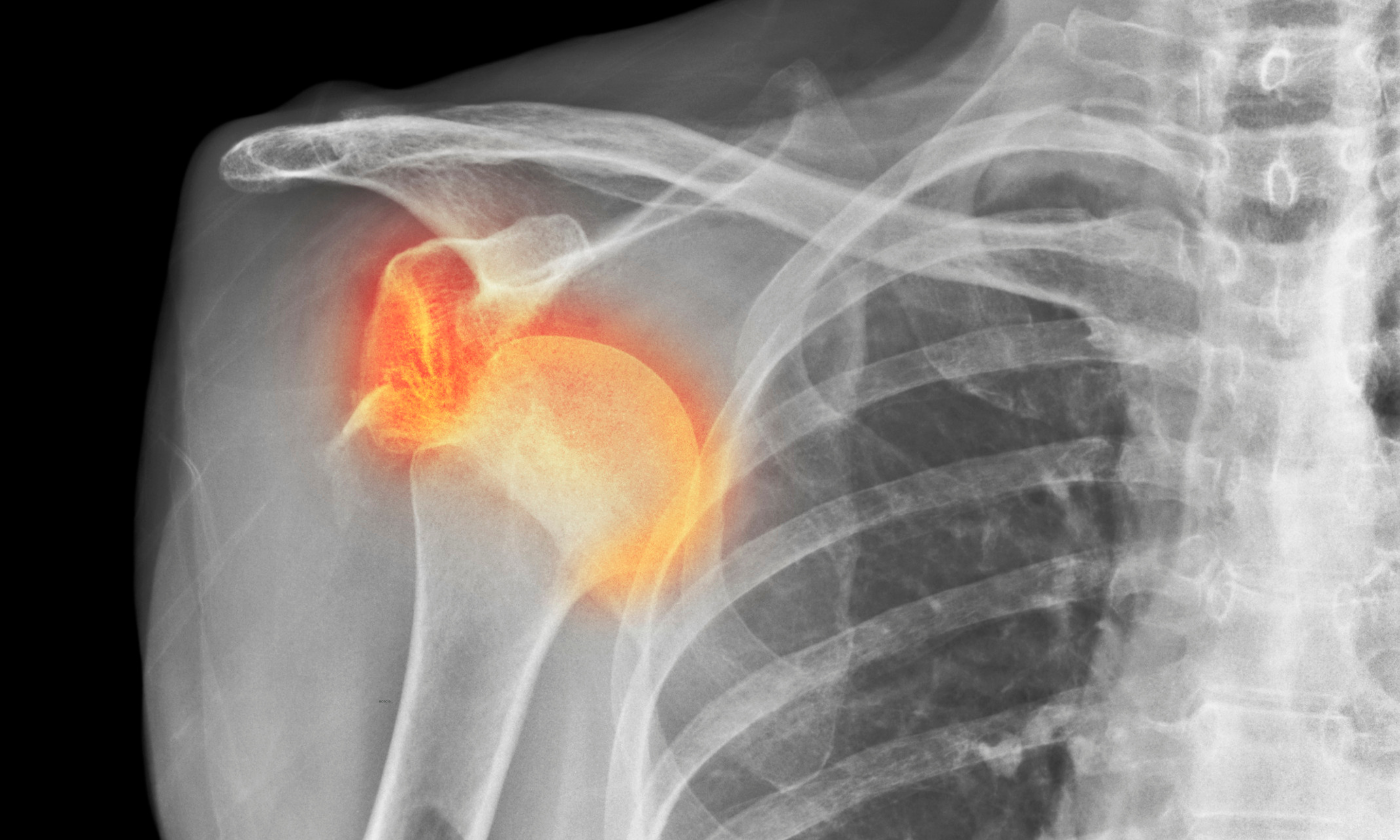 x-ray of dislocated shoulder