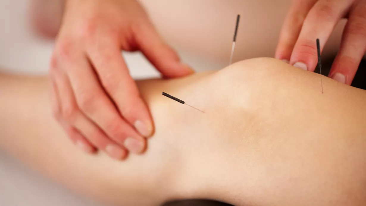 Acupuncture needles in a leg