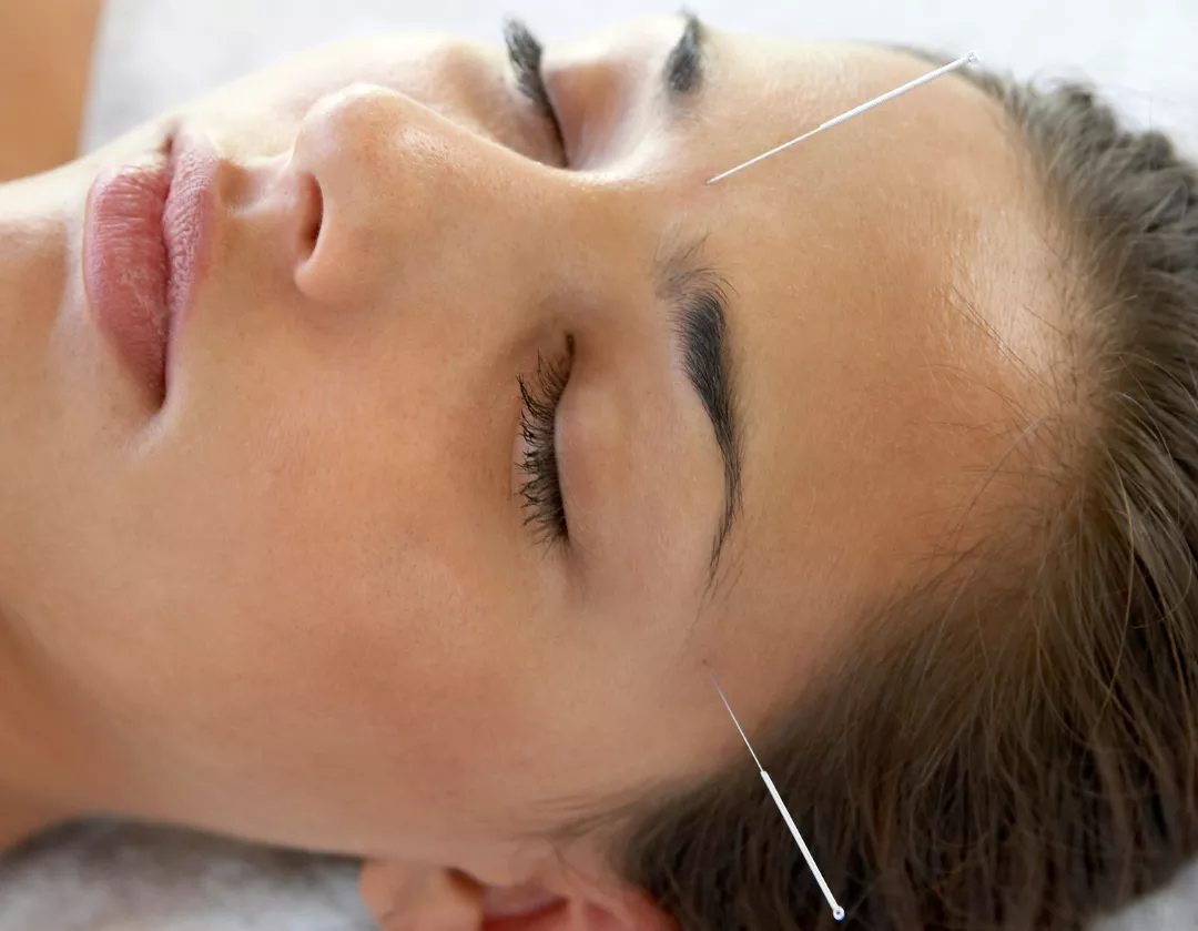 Patient getting acupuncture on their head and face