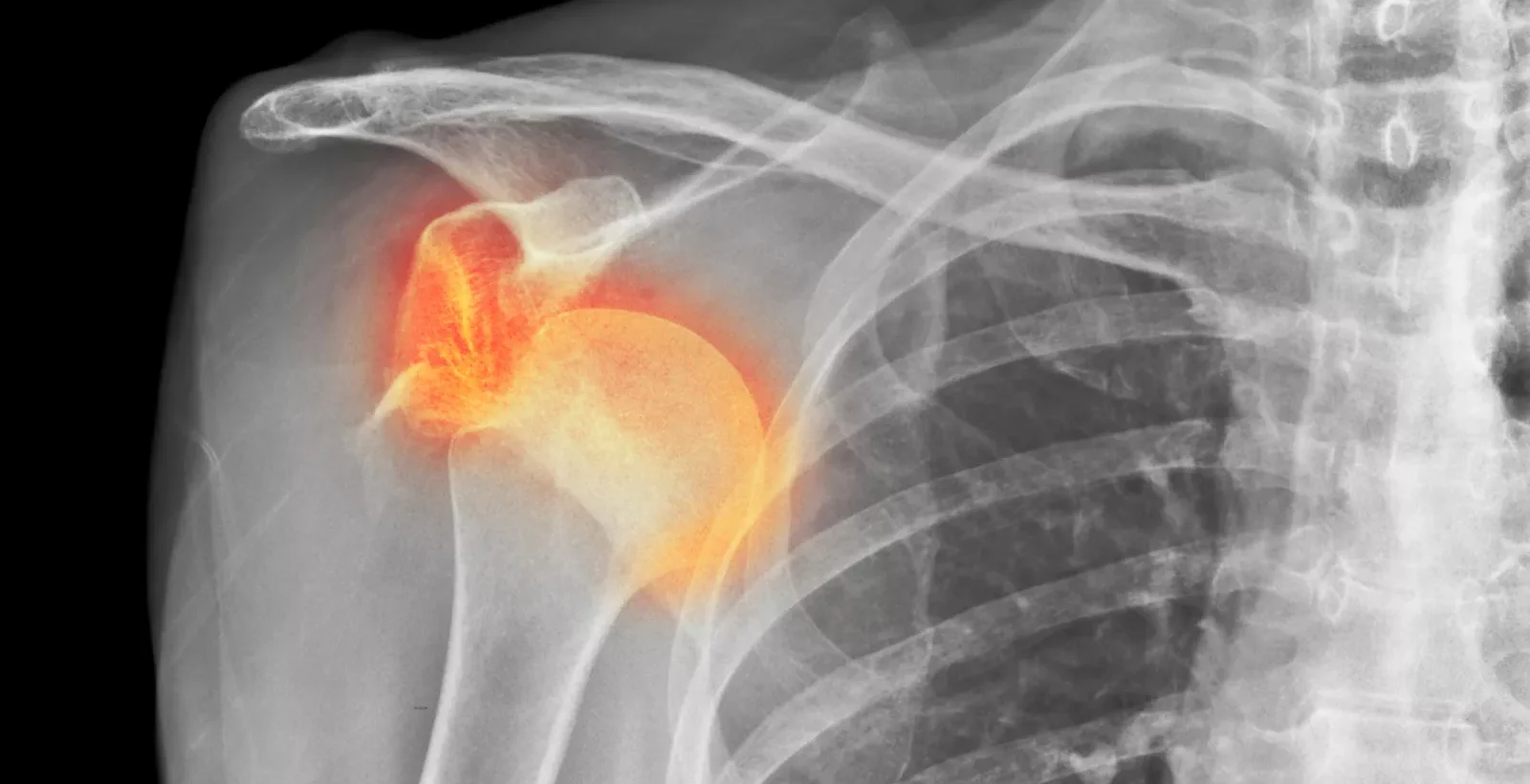 xray image of dislocated shoulder