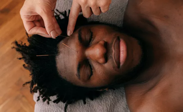 Acupuncture on face and head